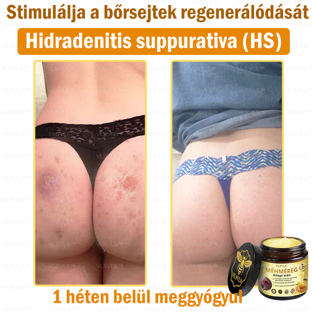 👑VLSVLS® Méhméreg Átfogó Krém (Minden korosztály számára alkalmas & HSME ajánlja)