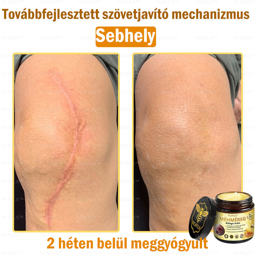 👑VLSVLS® Méhméreg Átfogó Krém (Minden korosztály számára alkalmas & HSME ajánlja)