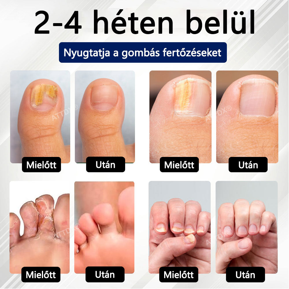 🎁Croaie® Fungiclear Méhterápiás Körömspray🎁