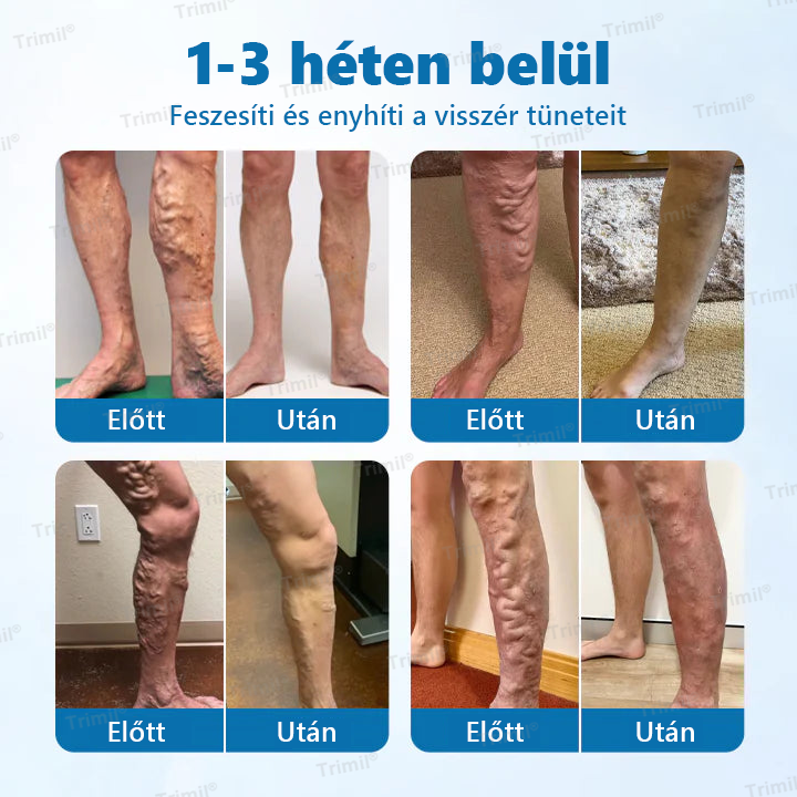 đđTrimilÂź VeinGuard GyĂłgynövĂ©nyes Spray - â
Klinikailag bizonyĂtott, hogy mindössze 7 nap alatt megszĂŒnteti a visszereket!