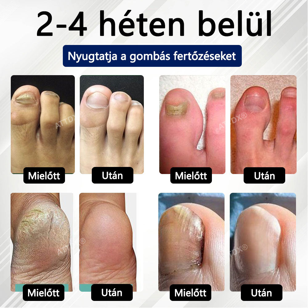 🎁Croaie® Fungiclear Méhterápiás Körömspray🎁