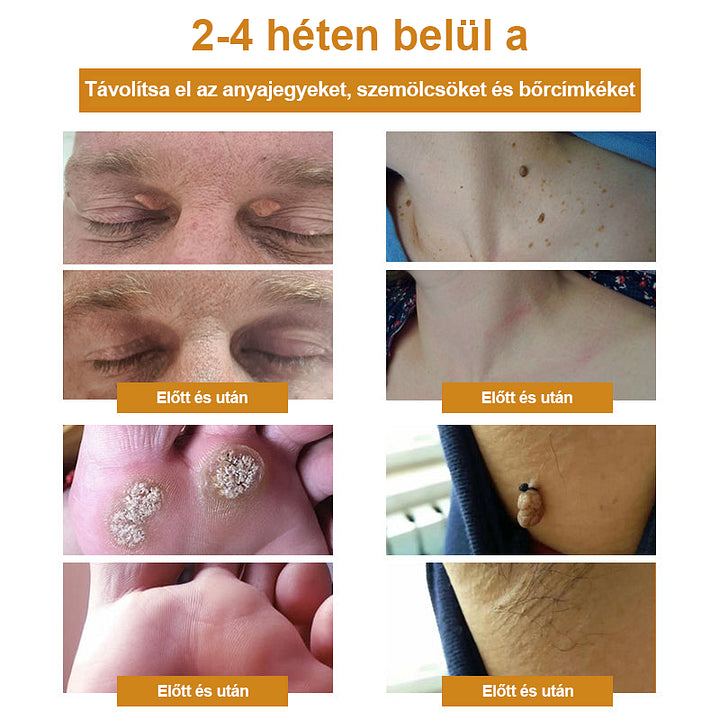đCvreoz spray szemölcsök Ă©s anyajegyek eltĂĄvolĂtĂĄsĂĄra mĂ©hmĂ©reggel (đšââDDG AJĂNLĂS)đđ(đ„utolsĂł napi ajĂĄnlat 80% kedvezmĂ©nnyel)