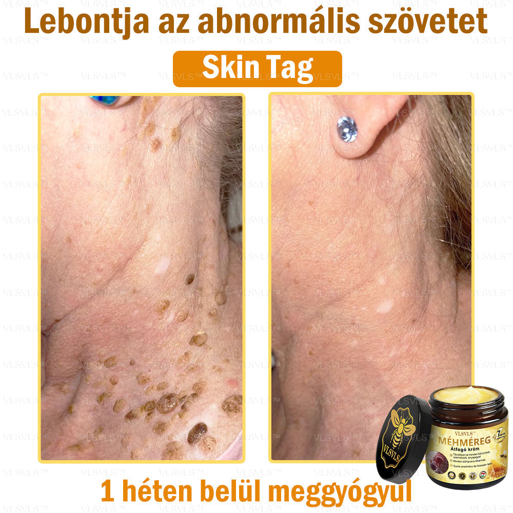 👑VLSVLS® Méhméreg Átfogó Krém (Minden korosztály számára alkalmas & HSME ajánlja)