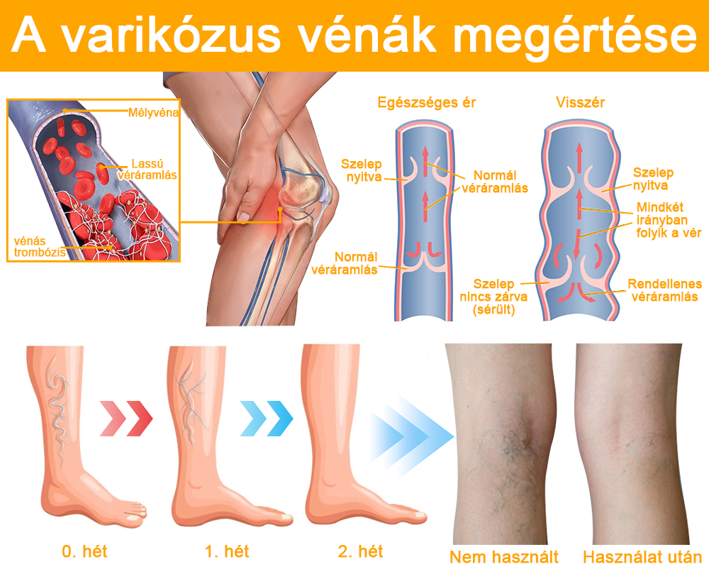 Furzero™ méhméreg visszér spray 🐝 🐝 🐝