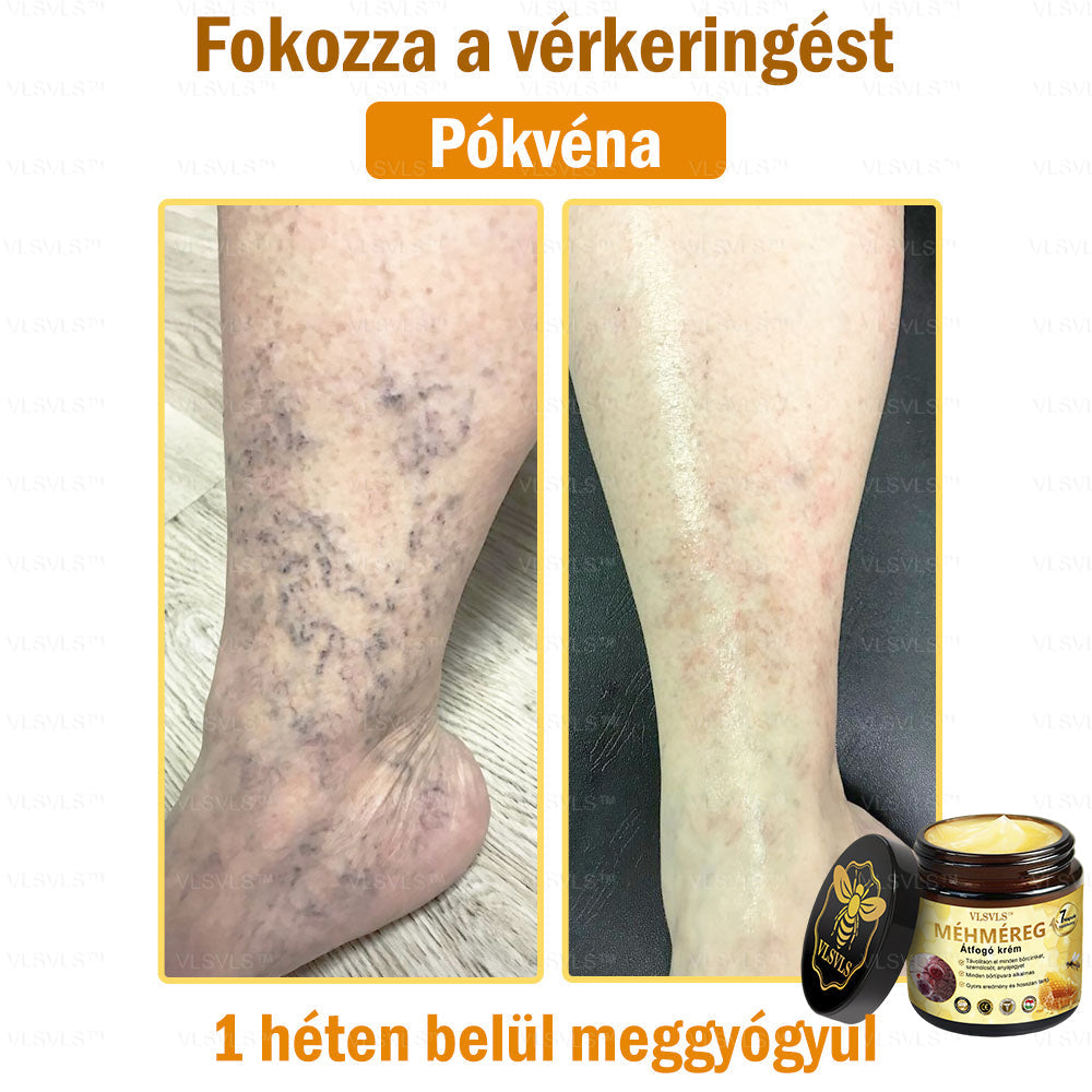 👑VLSVLS® Méhméreg Átfogó Krém (Minden korosztály számára alkalmas & HSME ajánlja)