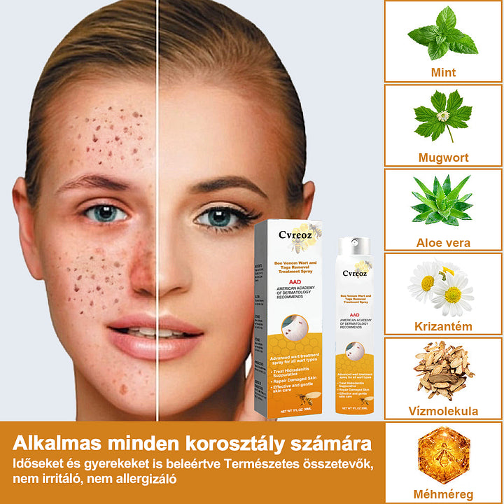đCvreoz spray szemölcsök Ă©s anyajegyek eltĂĄvolĂtĂĄsĂĄra mĂ©hmĂ©reggel (đšââDDG AJĂNLĂS)đđ(đ„utolsĂł napi ajĂĄnlat 80% kedvezmĂ©nnyel)
