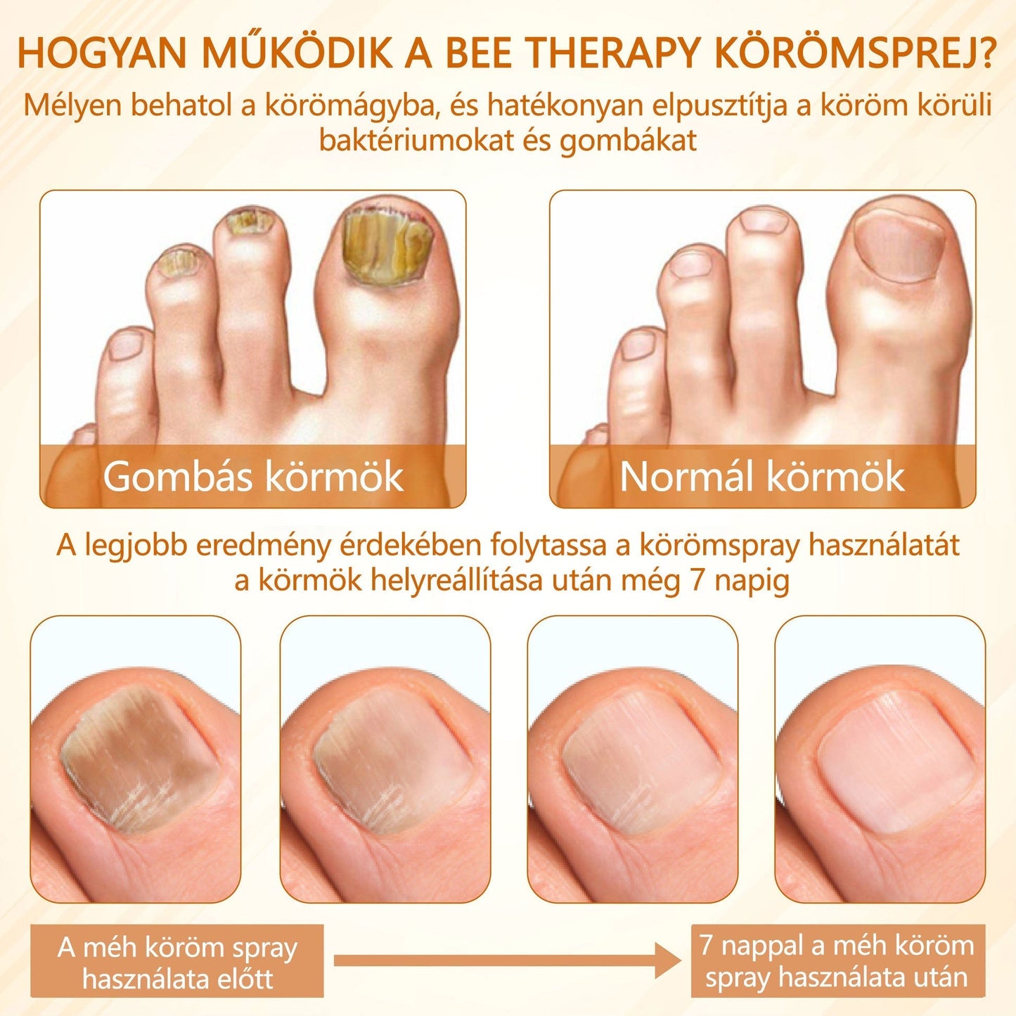 🎁Croaie® Fungiclear Méhterápiás Körömspray🎁