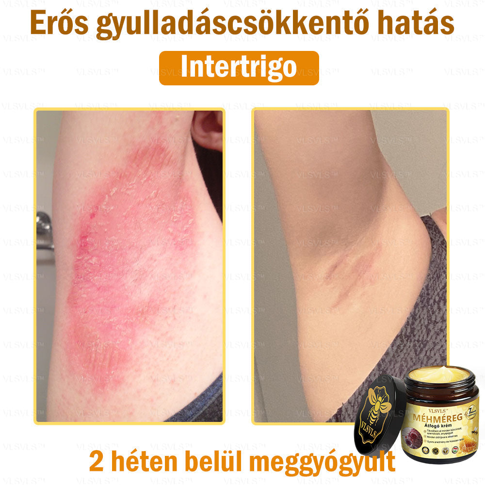 👑VLSVLS® Méhméreg Átfogó Krém (Minden korosztály számára alkalmas & HSME ajánlja)