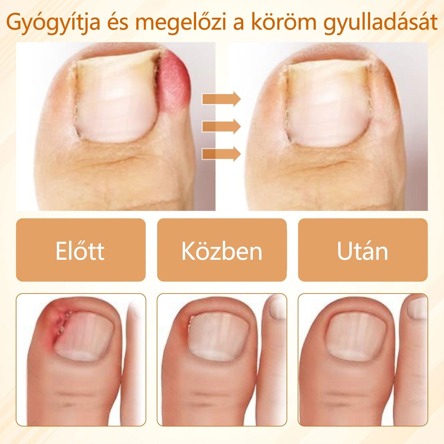 🎁Croaie® Fungiclear Méhterápiás Körömspray🎁