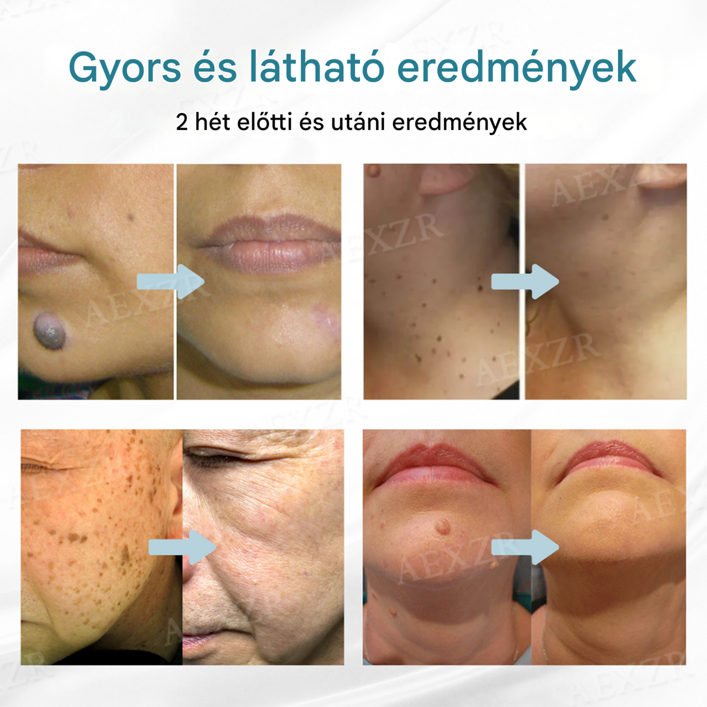 ✨Bikenda® non-invazív anyajegy- és szemölcseltávolító lézertoll✨✨