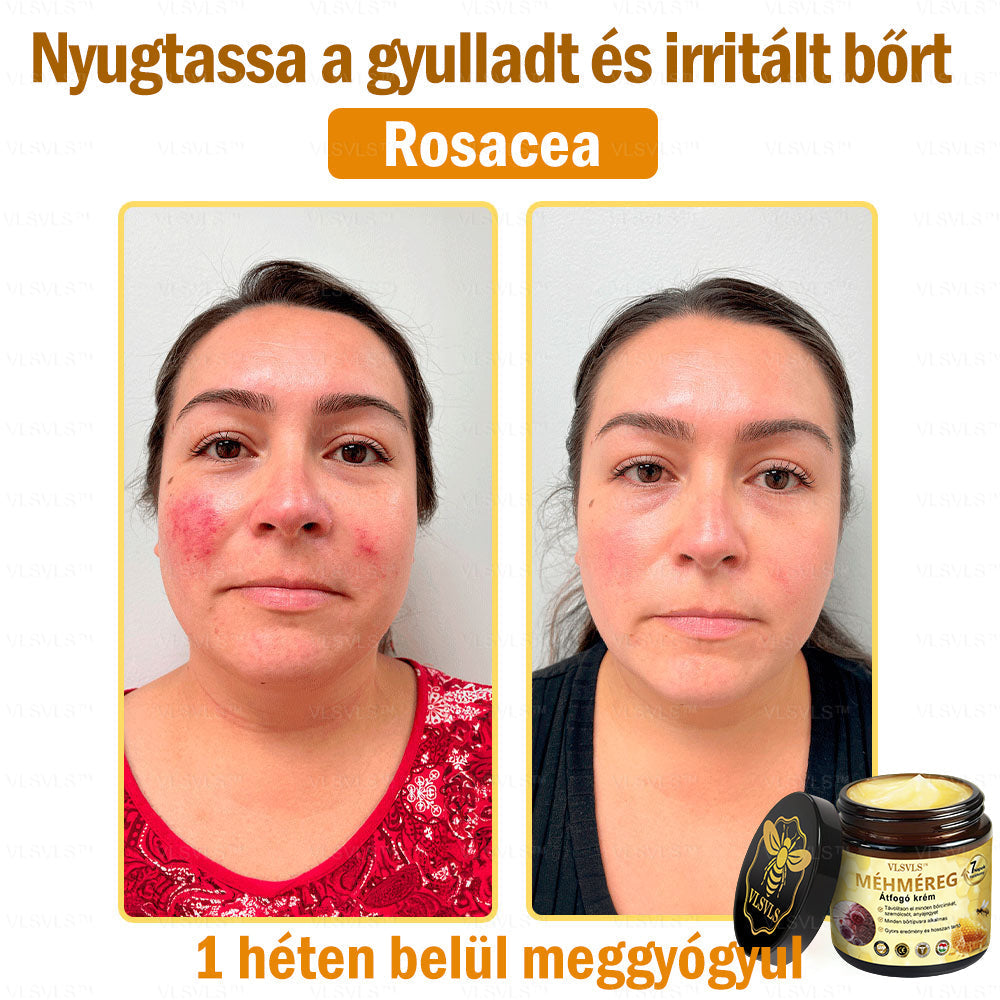 👑VLSVLS® Méhméreg Átfogó Krém (Minden korosztály számára alkalmas & HSME ajánlja)