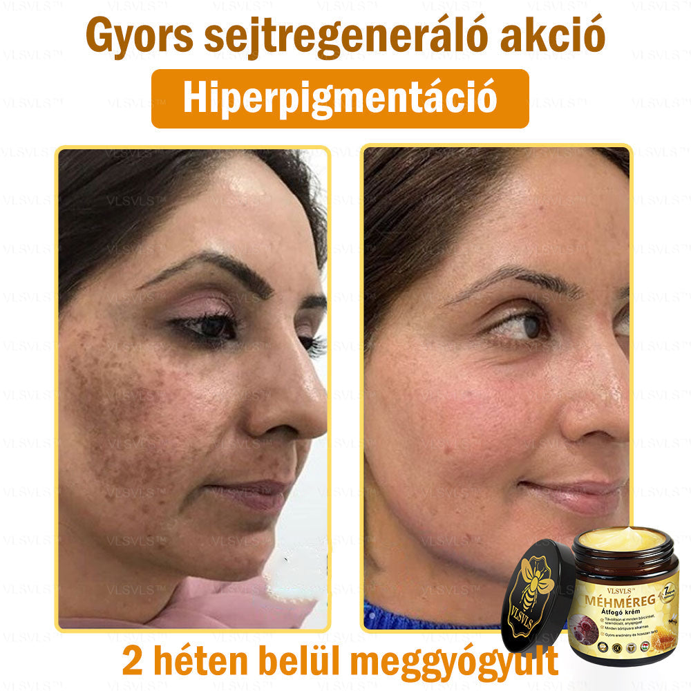 👑VLSVLS® Méhméreg Átfogó Krém (Minden korosztály számára alkalmas & HSME ajánlja)