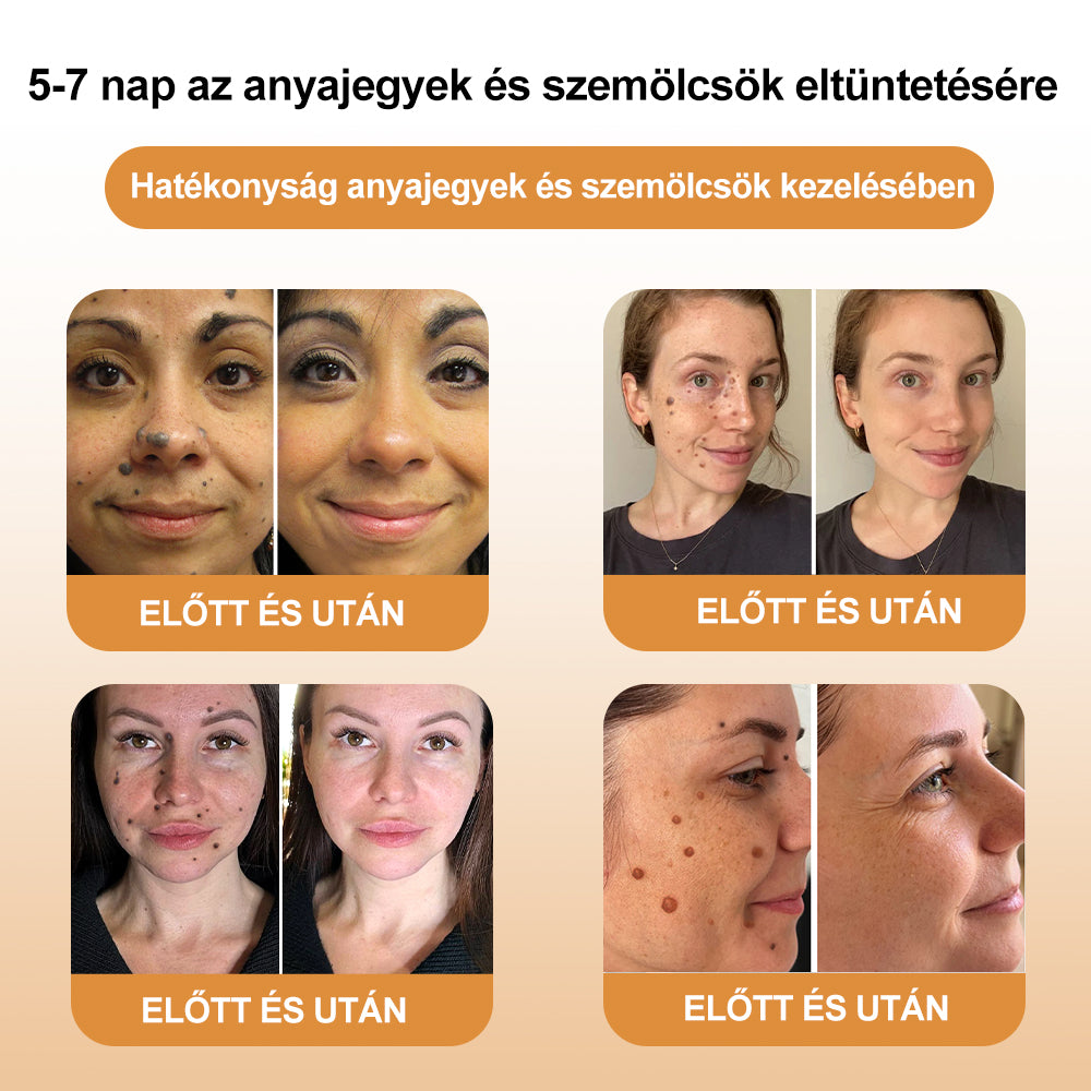 🌟🌟[✨Hivatalos Márkabolt✨] BőrGyógy™ Méhméreg Anyajegy és szemölcs kezelö krém(👨‍⚕️MSZ AJÁNLJA)