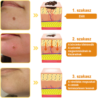 [💗utánvétel (COD)💗] Flysmus™Méhméreg szemölcs és övsömör eltávolító spray (👨‍⚕AAD Ajánlott) 🐝🐝🔥(🔥Last Day 80% Off)