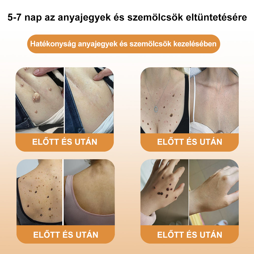 🐝🐝[✨Hivatalos Márkabolt✨] XRLXRL™ Méh Méreg Moll- és Szemölcskezelő Krém (👨‍⚕️MSZ AJÁNLJA)