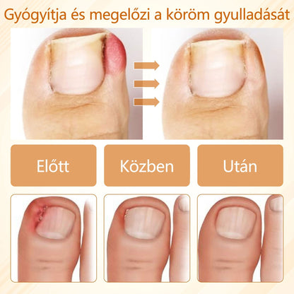 🎁Croaie® Fungiclear Méhterápiás Körömspray🎁